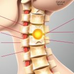 دیسک گردن : علل، علائم و درمان ها