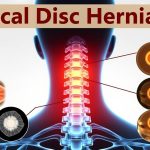 جراحی میکروسکوپیک دیسک گردن: روش جراحی، مزایا و معایب