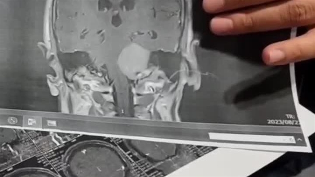 مراقبت‌های پس از جراحی تومور سی پی انگل(CP Angle Tumors)