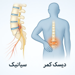 تفاوت سیاتیک و دیسک کمر: تشخیص و درمان